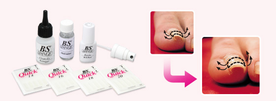 ドイツ式 巻爪矯正 B/Sブレイスクイック NEWS 新宿、中落合(落合南長崎