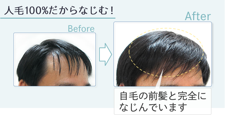 円形脱毛症やキズあとを増毛 | 増毛シート