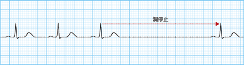 心電図でみる洞不全症候群(SSS)の波形・特徴とは？ | ナース専科