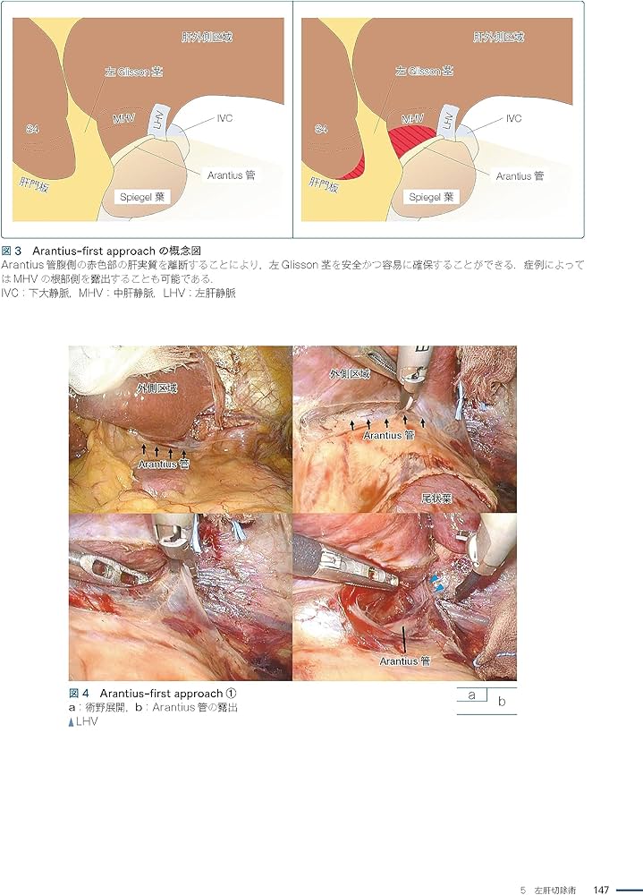 坂の上のラパ肝・胆・膵[Web動画付]: 腹腔鏡下手術が拓く肝胆膵外科の
