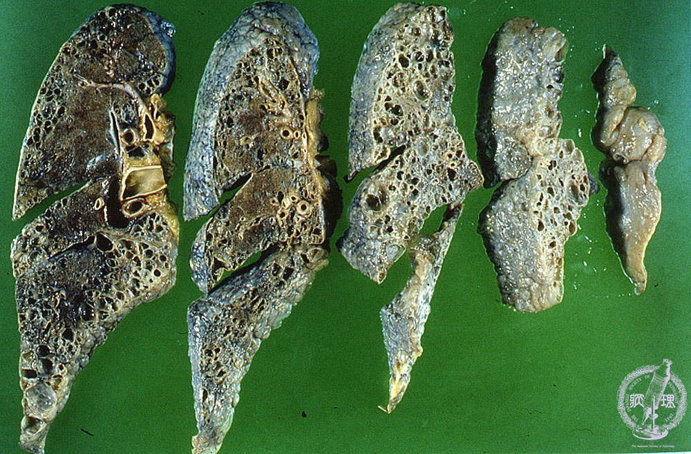 5.肺・胸膜 (12)間質性肺炎（肺線維症）|病理コア画像